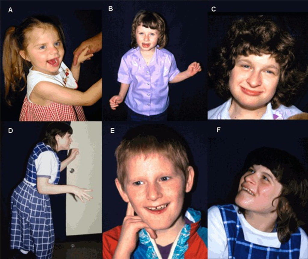 Individual with Angelman syndrome displaying characteristic happy demeanor and wide-based gait