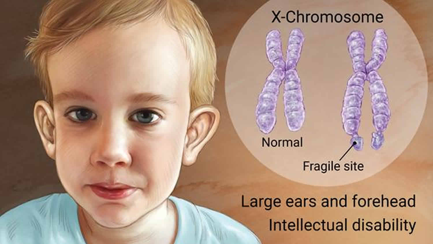 Individual with Fragile X syndrome showing characteristic physical features including long face, prominent ears, and high-arched palate