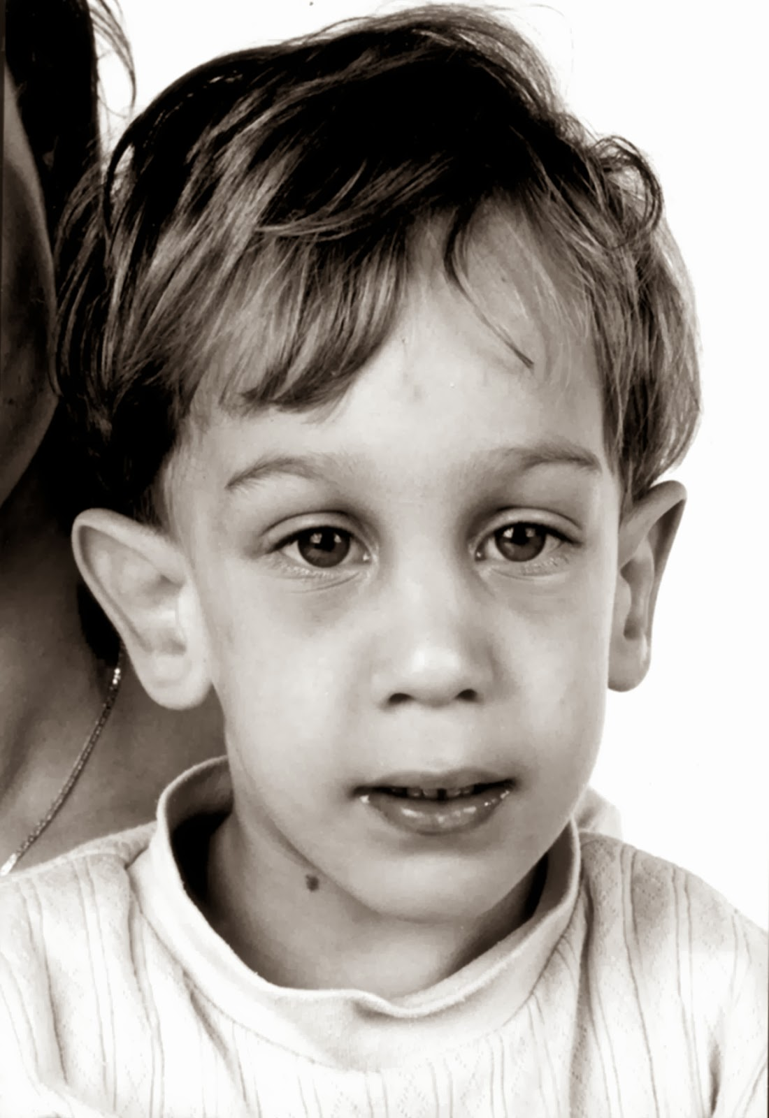 Clinical presentation showing developmental and behavioral features associated with Fragile X syndrome